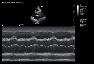 Cardiac M Mode(001)