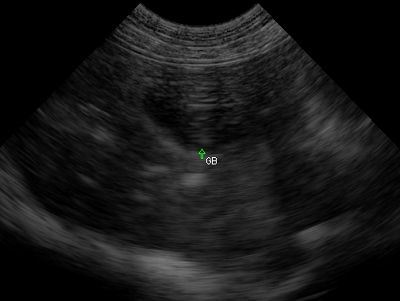 Gallbladder